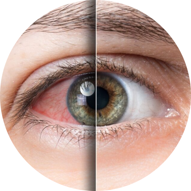 ipl-treatment-for-dry-eye-disease-1024x672-modified.png