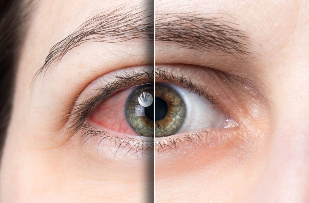 ipl-treatment-for-dry-eye-disease-1024x672.jpg